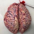 Intracerebral hemorrhage discovered during brain autopsy!