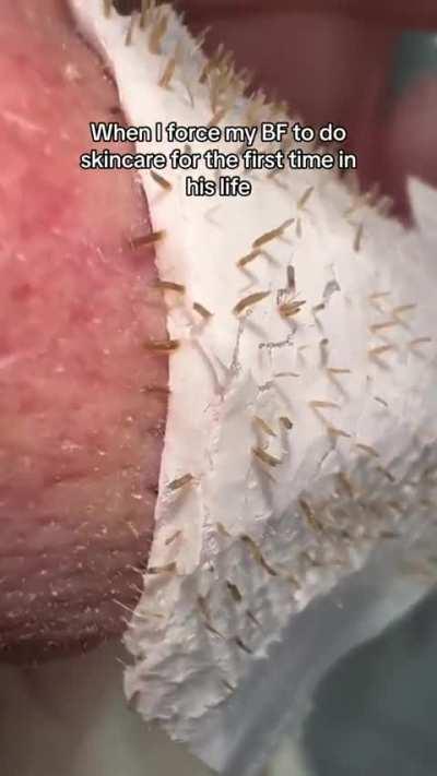Black head porestrips