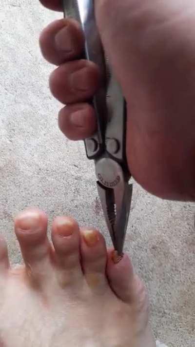 I too had a loose manky toenail and after stubbing it good last night decided to finish the job today