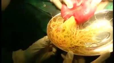 Removal of Intestinal worms. Ascaris Lumbricoides. Yes, from a human.