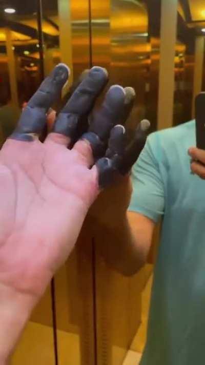 Man with frostbitten fingers