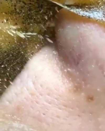 thanks I hate pimple removal mask