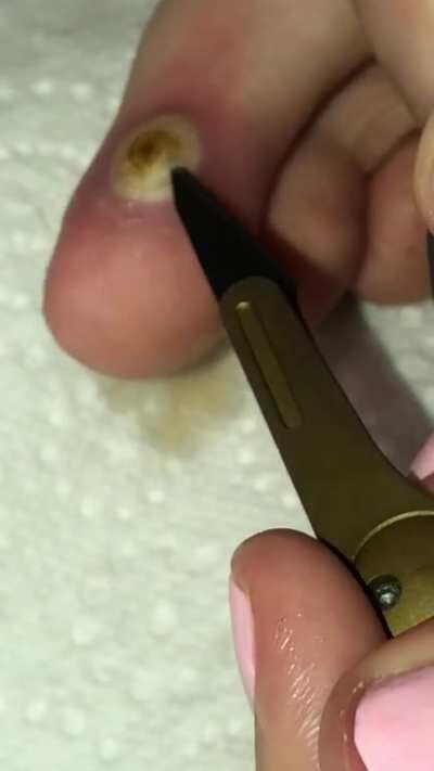 wart removal after 2 weeks of wart-off