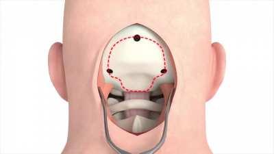 How a craniectomy is performed to remove a tumor from the brain.