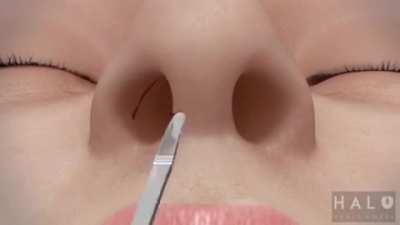 How Rhinoplasty (Nose Job) Is Done