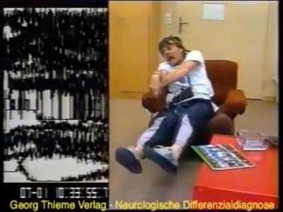 A man having an epileptic seizure and his brain waves