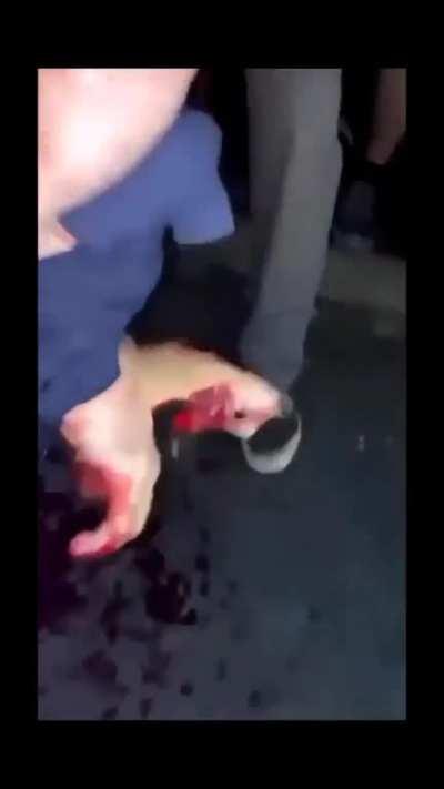 Launches Firework in Hand and Sustains Damage