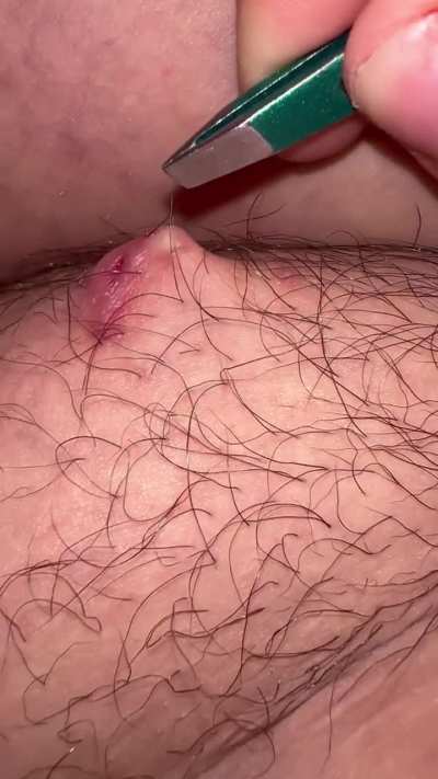 Chronic Infected Ingrown Hair pt. 2