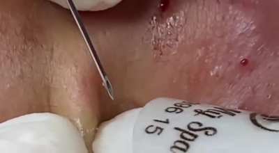Blackheads