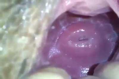 Asian hairy cervix