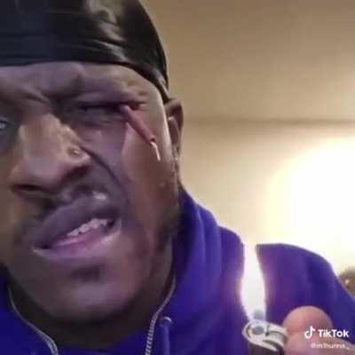 Putting a firecracker in your eye