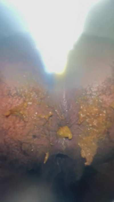 I’ve been so constipated lately. Took some laxatives & barely made it.