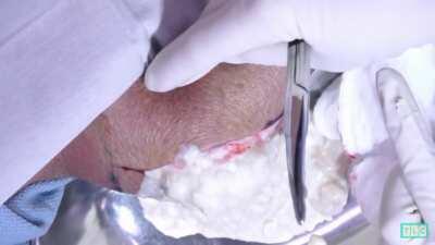Guy had a cyst build up for much too long. Now has a knee full of cottage cheese.