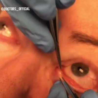 Thanks, I hate eyelid pop.