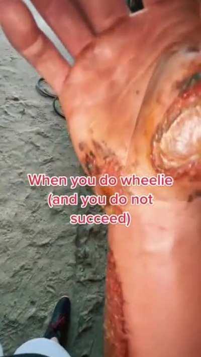 That's what happens if you don't wear moto gear....