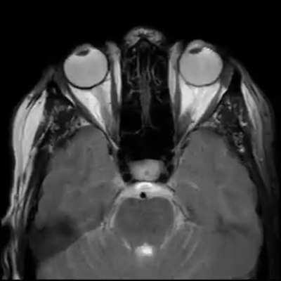 MRI scan of a person moving their eyes back and forth