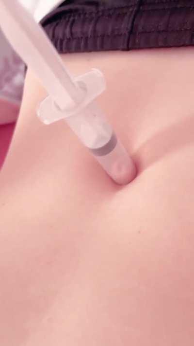 innie navel extracted 