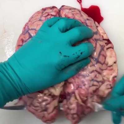 Intracerebral hemorrhage discovered during brain autopsy