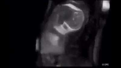 One of the clearest images of human baby inside womb using MRI.