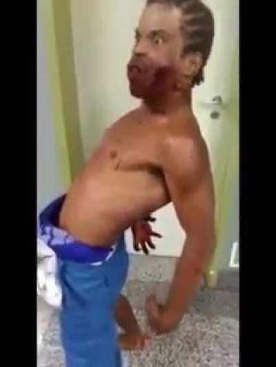 guy walks in hospital high on drugs, with gunshot in his face