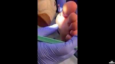 Thanks, I hate giant splint removals