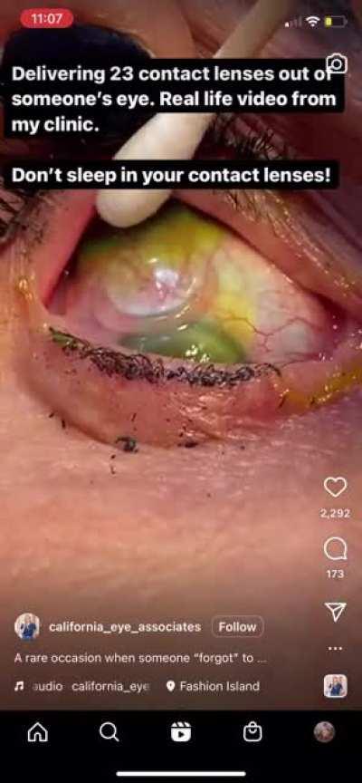 Multiple contacts being delivered from an eyeball. Remember to take out your contacts before bed kids….