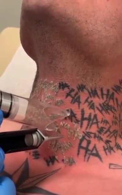 Удаление татуировок