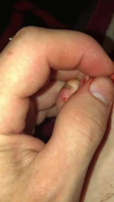 taking off this hanging toenail