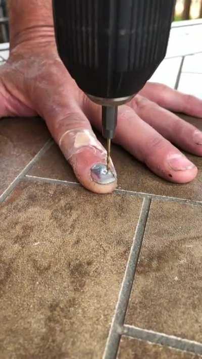 My dad self drilling a hole in his nail to relieve pressure.