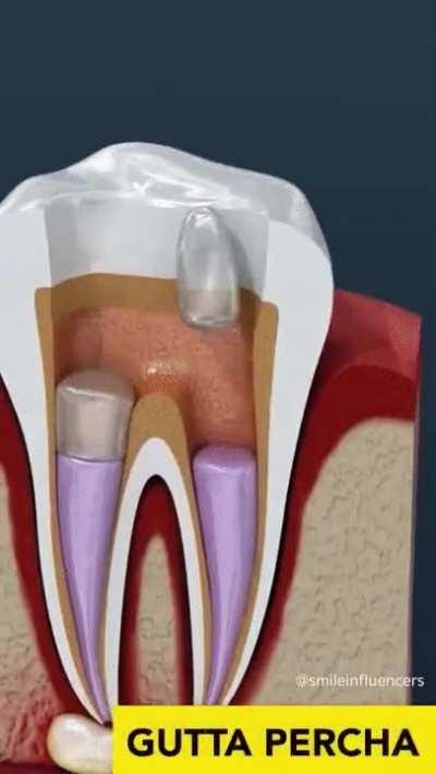 Tooth cavity and root canal treatment