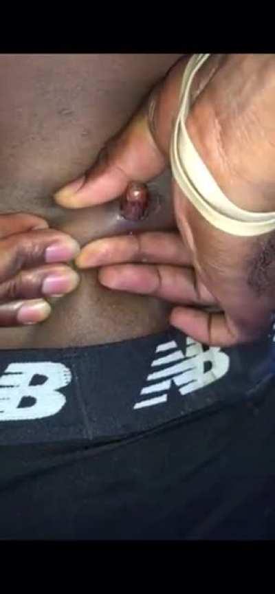 After being shot 2 years ago, he squeezes the bullet out of his own body.