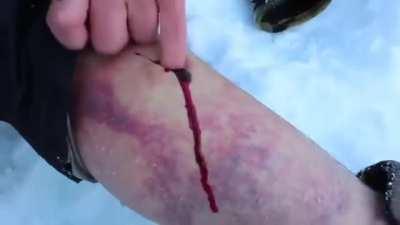 Vlad calmly doing emergency hematoma surgery on himself in the snowy wilderness