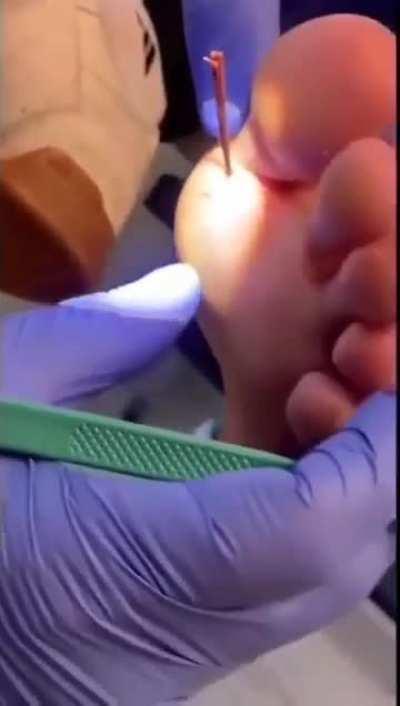 Man undergoes surgery for a splinter. 