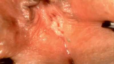 bladder gelatin egg insertion & endoscopy