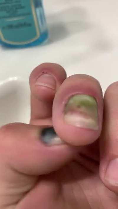 Crushed some fingers at work