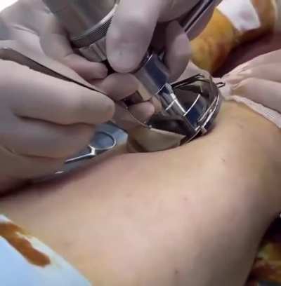 This is how skin is harvested for grafting