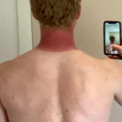 Alle har filur (husk solcreme)