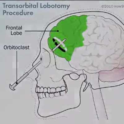 Cat becoming lobotomized (funny) (cann