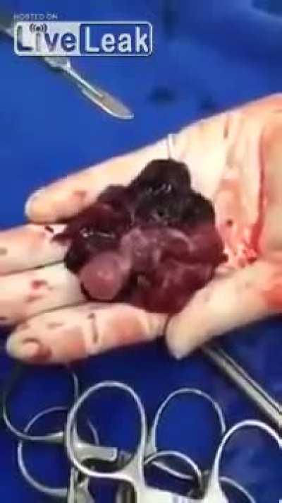 Recently aborted fetus, still alive after op