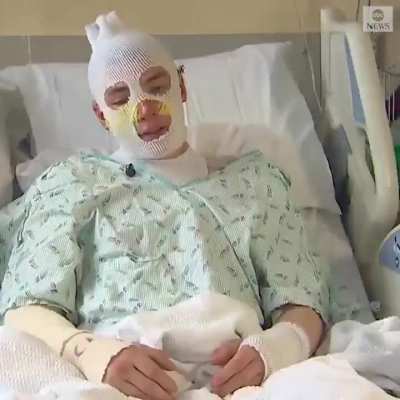 Derrick Byrd, 20, sustained second- and third-degree burns on his face, arms, and back after rushing back into a burning home to save his 8-year-old niece. Derrick Byrd is the definition of a true hero. 🙏