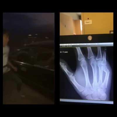 My nephew breaking his hand