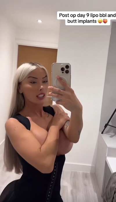 🇬🇧 9 day post op butt implants + BBL