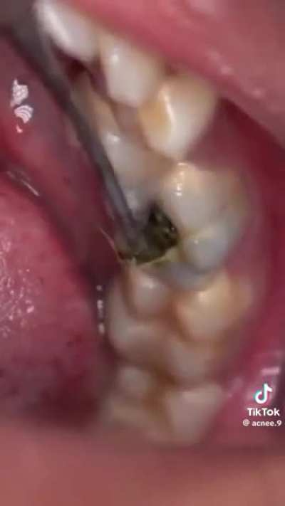 Dentist: Did you have corn for lunch? Patient: No that was yesterday. 