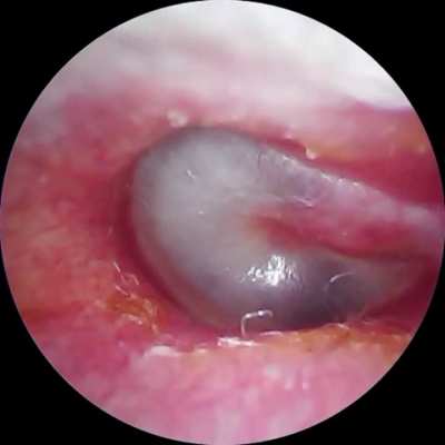 Ever wondered what it looks like when you pop your ears while you have a fluid build up behind the eardrum? Now you know :)