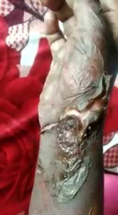 Фейерверк взорвался в руке