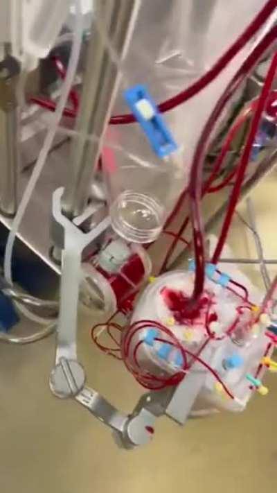 A heart that will be transplanted.