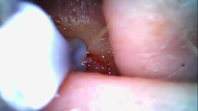 Ear pop round 2 part 2