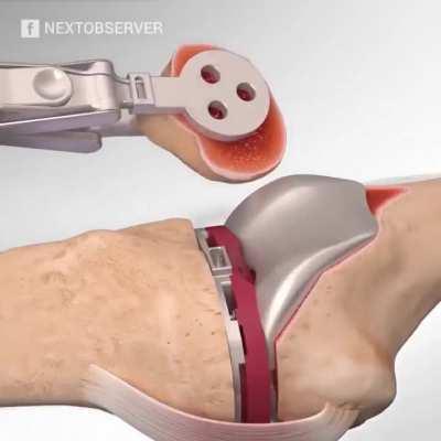 This is how doctors perform knee replacement surgery