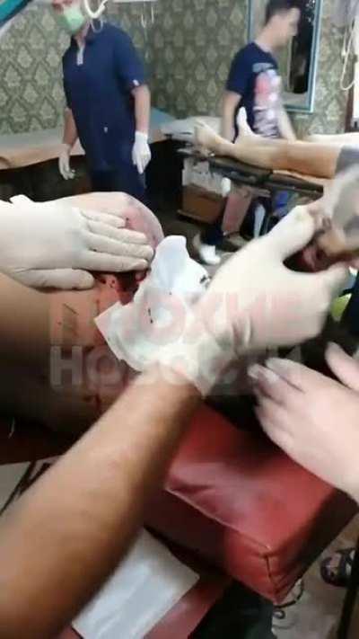 A mine shank lodged in the soldier's shoulder. The victim held on as best he could, but complained that 