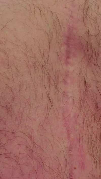 My partially artificial heart seen through my chest.